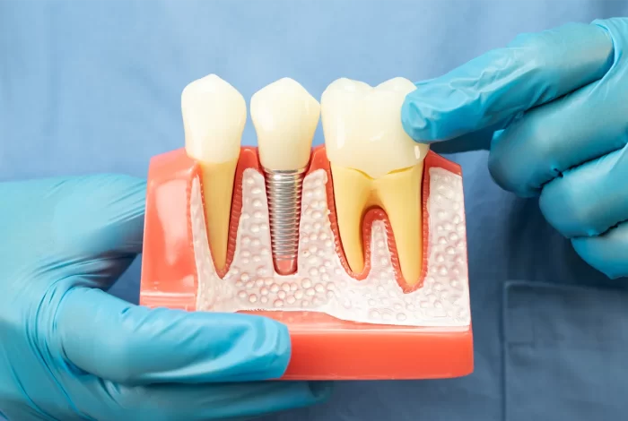 asian-dentist-holding-dental-implant-artificial-t-2025-04-10-17-28-40-utc asian-dentist-holding-dental-implant-artificial-t-2025-04-10-17-28-40-utc