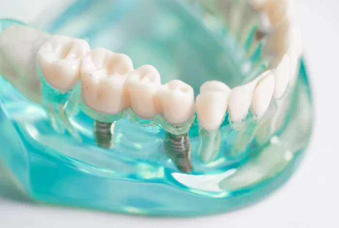 dental-implant-artificial-tooth-roots-into-jaw-r-2025-02-24-17-11-27-utc dental-implant-artificial-tooth-roots-into-jaw-r-2025-02-24-17-11-27-utc